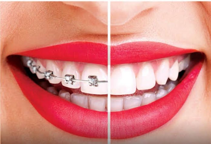 4 COMMON ALTERNATIVES TO METAL BRACES