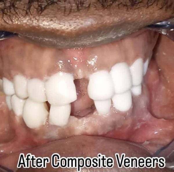 Veneer Composite - Image 2